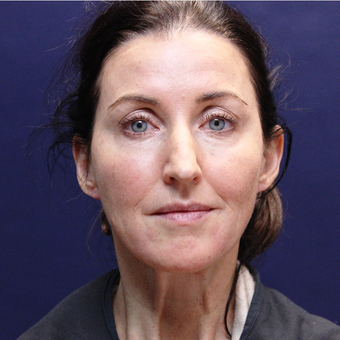 45-54 year old woman treated with Injectable Fillers after 3202219