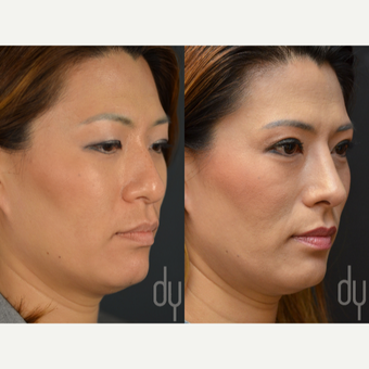 25-34 year old woman treated with Asian Eyelid Surgery before 2990848