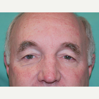 Eyelid Surgery before 3743976