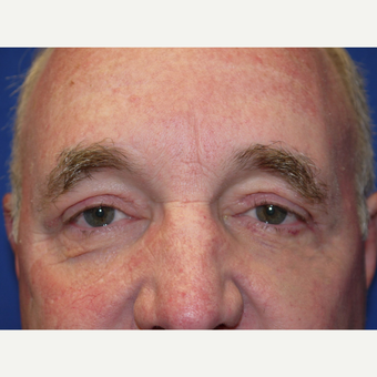 Eyelid Surgery after 3743976