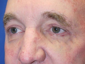 Eyelid Surgery 3743976