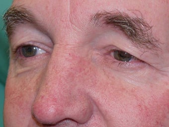 Eyelid Surgery 3743976