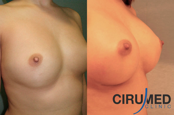 Supercharged breast augmentation (fat transfer/silicone) after 1035121