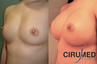 Supercharged breast augmentation (fat transfer/silicone) before 1035121