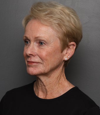 Facelift before 3781638