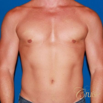 41 year old body builder treated with male breast reduction after 3502281