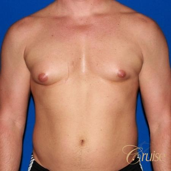 41 year old body builder treated with male breast reduction before 3502281