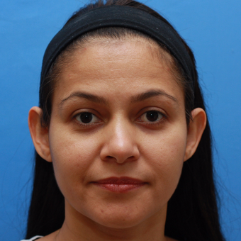 Young woman bothered by her prominent ears. She is interested in Otoplasty before 3670707
