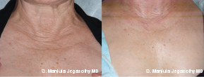 Platelet-Rich-Plasma Injections in the Lower Neck and Upper Chest before 1547461