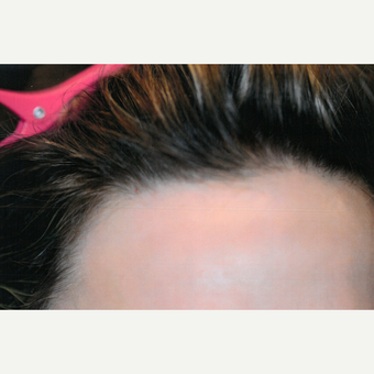 55-64 year old woman treated with PRP for Hair Loss after 3803921