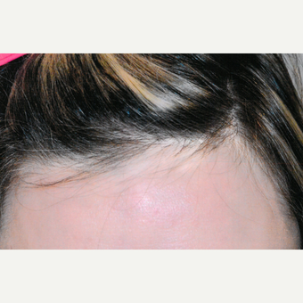 55-64 year old woman treated with PRP for Hair Loss before 3803921