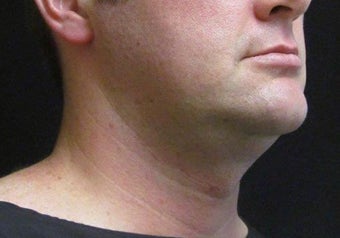 33 year old man treated with NeckTite RFAL before 3683575