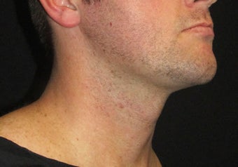 33 year old man treated with NeckTite RFAL after 3683575