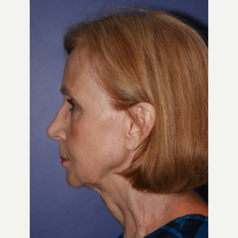 67 year old woman treated with Facelift before 3710707