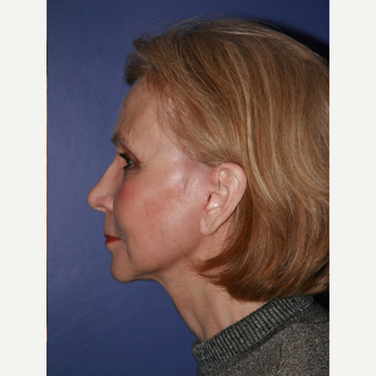 67 year old woman treated with Facelift after 3710707