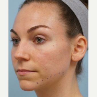 25-34 year old woman treated with Acne Scars Treatment before 3727562