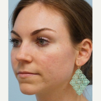 25-34 year old woman treated with Acne Scars Treatment after 3727562