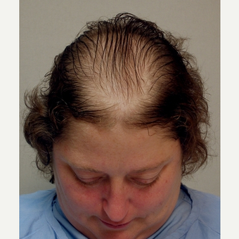 Hair Transplant before 3241463