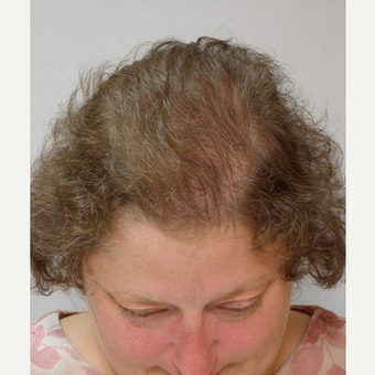 Hair Transplant after 3241463