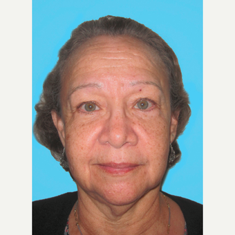 Facelift before 3826845