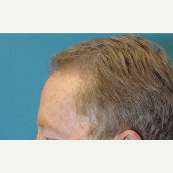 60 year old man treated with NeoGraft FUE transfer of 3000 grafts after 3770125
