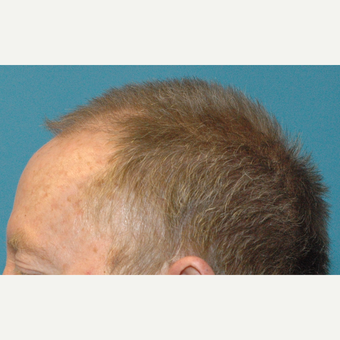 60 year old man treated with NeoGraft FUE transfer of 3000 grafts before 3770125