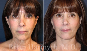 62 year-old female before and 3.5 months after Facelift and Fat Transfer (Autologous Fat Transplant) before 3445860