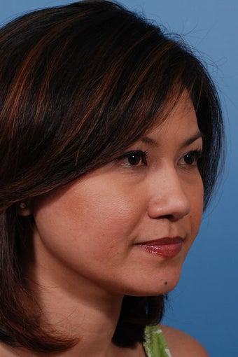 Asian Rhinoplasty after 89925