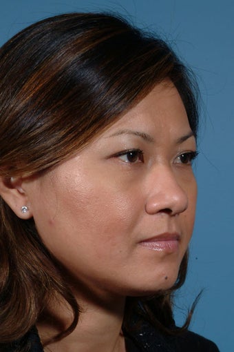 Asian Rhinoplasty before 89925