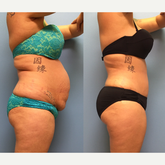 30 year-old woman treated with Tummy Tuck and Lipo 360 before 3494878