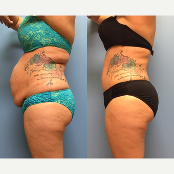 30 year-old woman treated with Tummy Tuck and Lipo 360 after 3494878
