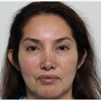 45-54 year old woman treated with Rhinoplasty before 3442528
