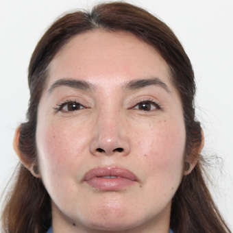 45-54 year old woman treated with Rhinoplasty after 3442528
