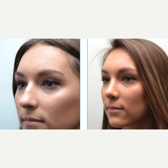 18-24 year old woman treated with Rhinoplasty after 3747720