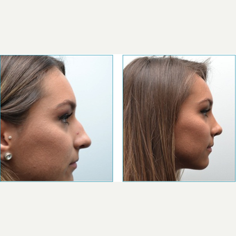 18-24 year old woman treated with Rhinoplasty before 3747720