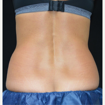 25-34 year old woman treated with CoolSculpting before 3239528