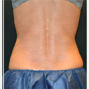 25-34 year old woman treated with CoolSculpting after 3239528
