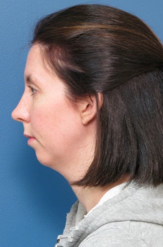 Chin Liposuction & Chin Implant before 338473