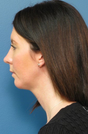 Chin Liposuction & Chin Implant after 338473