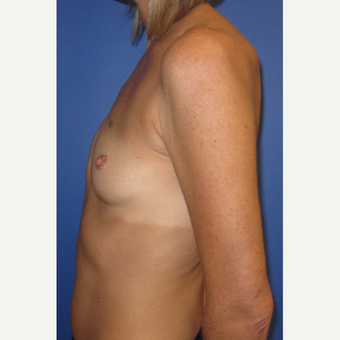 35-44 year old woman treated with Breast Implants (371cc) before 3098484