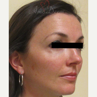 35-44 year old woman treated with Belotero after 3222792