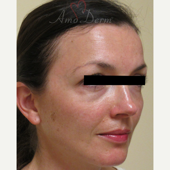 35-44 year old woman treated with Belotero before 3222792