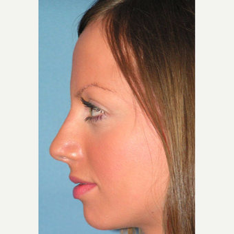 25-34 year old woman treated with Rhinoplasty after 3499848