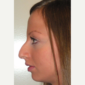 25-34 year old woman treated with Rhinoplasty before 3499848