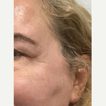 45-54 year old woman treated with Microneedling after 2881617