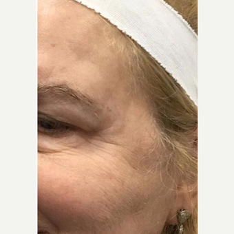 45-54 year old woman treated with Microneedling before 2881617
