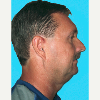 Neck Lift before 3824749