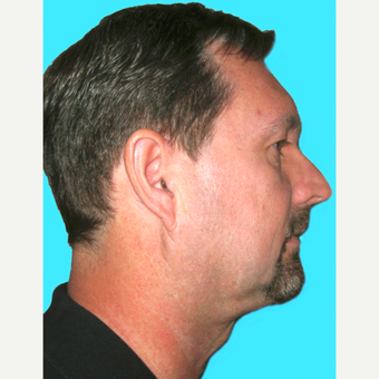 Neck Lift after 3824749