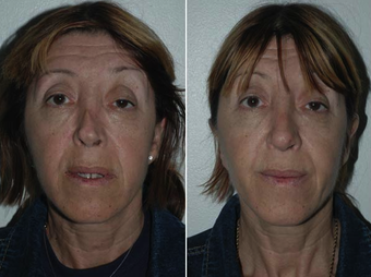 Revision Rhinoplasty before 229629