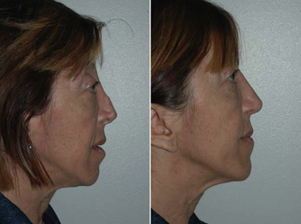 Revision Rhinoplasty after 229629